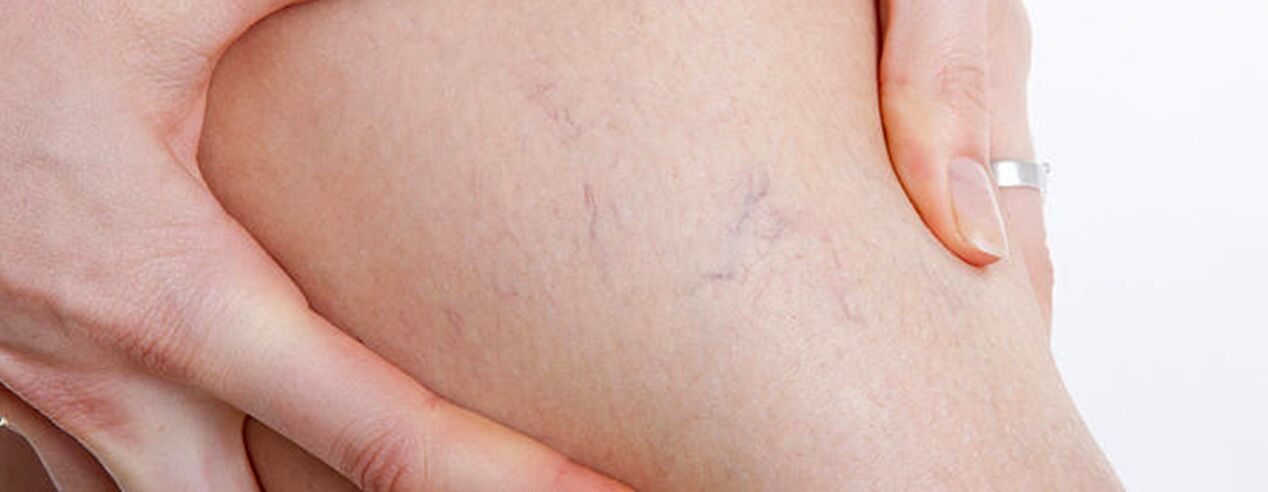 how varicose veins occur