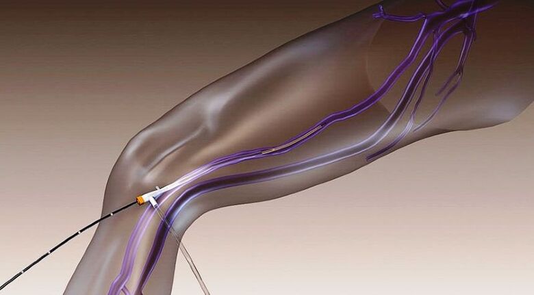 Radiofrequency ablation - a method for treating varicose veins